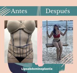 Lipoabdomindoplastia - Dr. Fernando Gallardo García