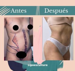 Dr. Fernando Gallardo - Lipoescultura