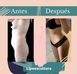 Lipoescultura - Dr. Fernando Gallardo