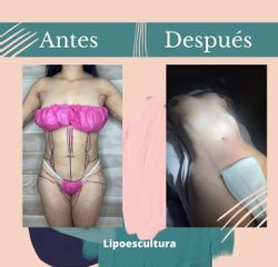 Lipoescultura - Dr. Fernando Gallardo