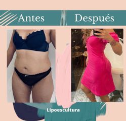 Lipoescultura - Dr. Fernando Gallardo