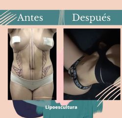 Lipoescultura - Dr. Fernando Gallardo