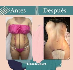 Lipoescultura - Dr. Fernando Gallardo
