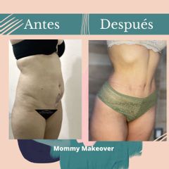 Mommy makeover - Dr. Fernando Gallardo