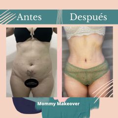 Mommy makeover - Dr. Fernando Gallardo
