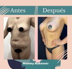 Mommy makeover - Dr. Fernando Gallardo