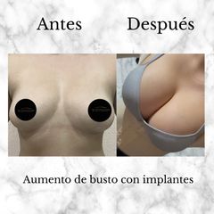 Aumento de busto con implantes