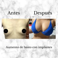 Aumento de busto con implantes