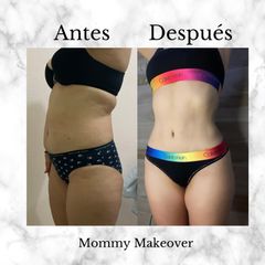 Mommy Makeover