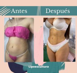 Lipoescultura - Dr. Fernando Gallardo García