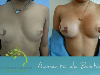 Antes y después de Aumento de busto