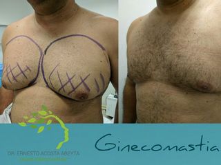 Antes y después de Tratamiento de ginecomastia