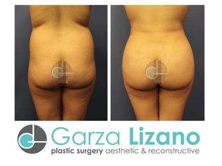 Antes y después de Lipoescultura