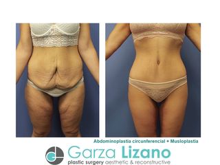 Antes y después de Abdominoplastia