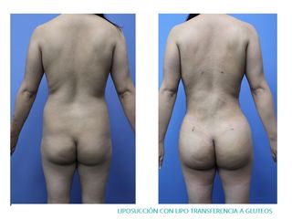 Antes y después de Lipoescultura
