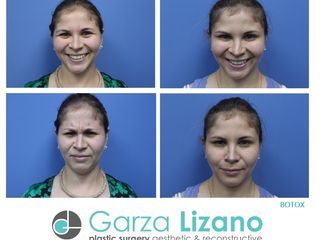 Antes y después de toxina botulínica