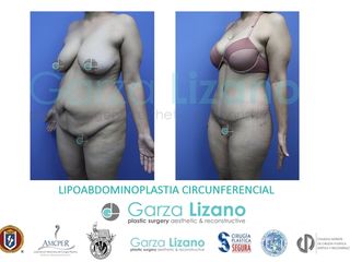Antes y después de Abdominoplastia