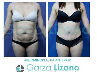 Antes y después de Abdominoplastia