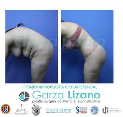 Antes y después de Lipoabdominoplastia Circunferencial 