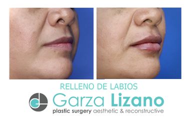 Aumento de labios - Dr. Garza Lizano