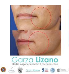 Bolsas de bichat - Dr. Garza Lizano