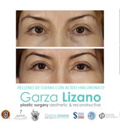 Ácido hialurónico - Dr. Garza Lizano
