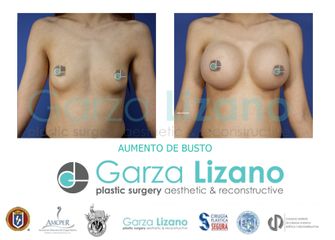 Antes y después de Aumento de busto 