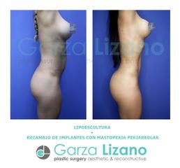 Antes y después de Lipoescultura