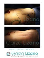 Antes y después de Abdominoplastia