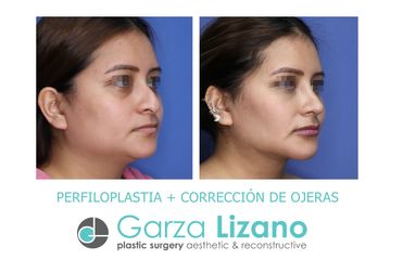 Rinoplastia - Dr. Garza Lizano