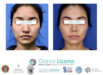 Liposucción de papada - Dr. Garza Lizano