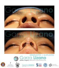Rinoplastia - Dr. Garza Lizano