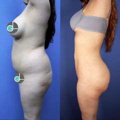 Antes y después de Liposucción con Lipo infiltración Glútea