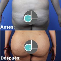 Antes y después de lipo+infiltración glútea