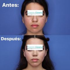 Antes y después de Rinoplastia + bichatectomia + liposucción de papada +infiltración facial