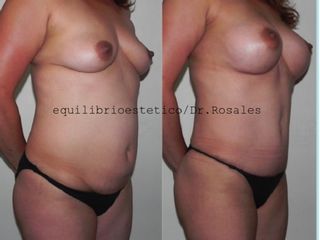 Antes y después de Abdominoplastia con aumento de busto