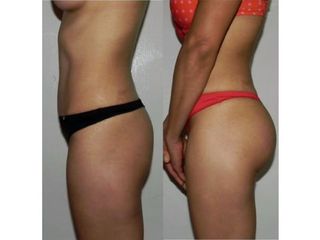 Antes y después de Implantes de glúteos