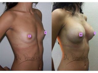 Antes y después de Aumento de busto