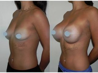 Antes y después de Aumento de busto