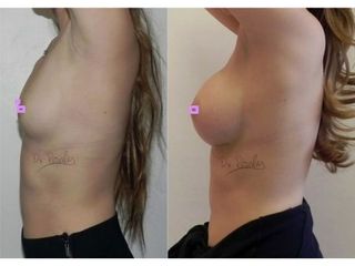 Antes y después de Aumento de busto