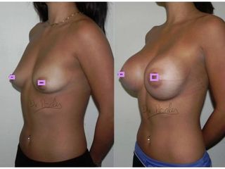 Antes y después de Aumento de busto