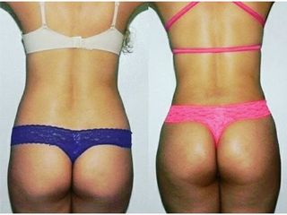 Antes y después de Lipoescultura