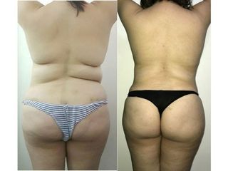Antes y después de Lipoescultura