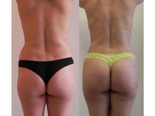 Antes y después de Lipoescultura