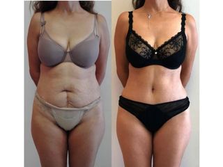 Antes y después de Abdominoplastia