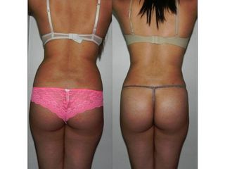 Antes y después de Lipoescultura