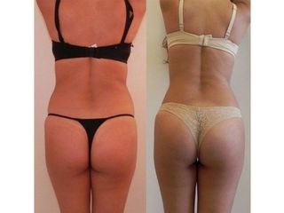 Antes y después de Lipoescultura