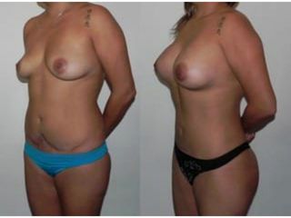 Antes y después de Abdominoplastia
