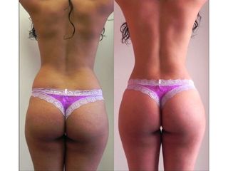 Antes y después de Lipoescultura