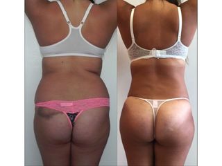 Antes y después de Lipoescultura